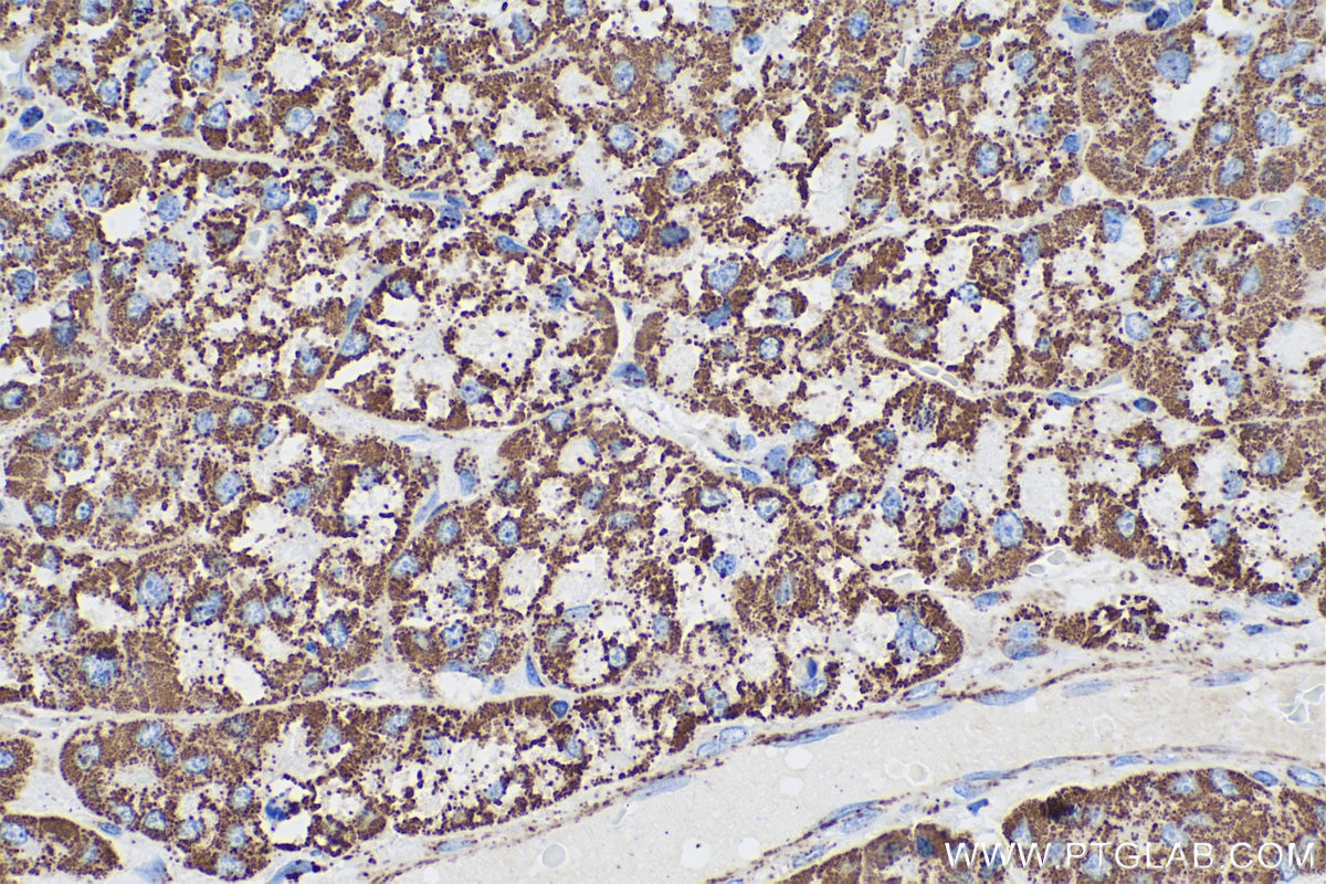 Immunohistochemistry (IHC) staining of human liver cancer tissue using ETFA Monoclonal antibody (67661-1-Ig)