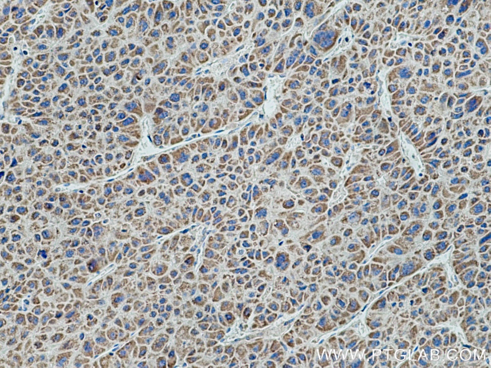 IHC staining of human liver cancer using 11109-1-AP