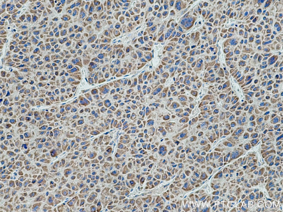 Immunohistochemistry (IHC) staining of human liver cancer tissue using ETFDH Polyclonal antibody (11109-1-AP)