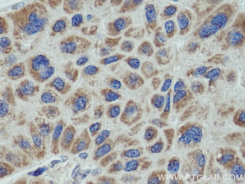 Immunohistochemistry (IHC) staining of human liver cancer tissue using ETFDH Polyclonal antibody (11109-1-AP)