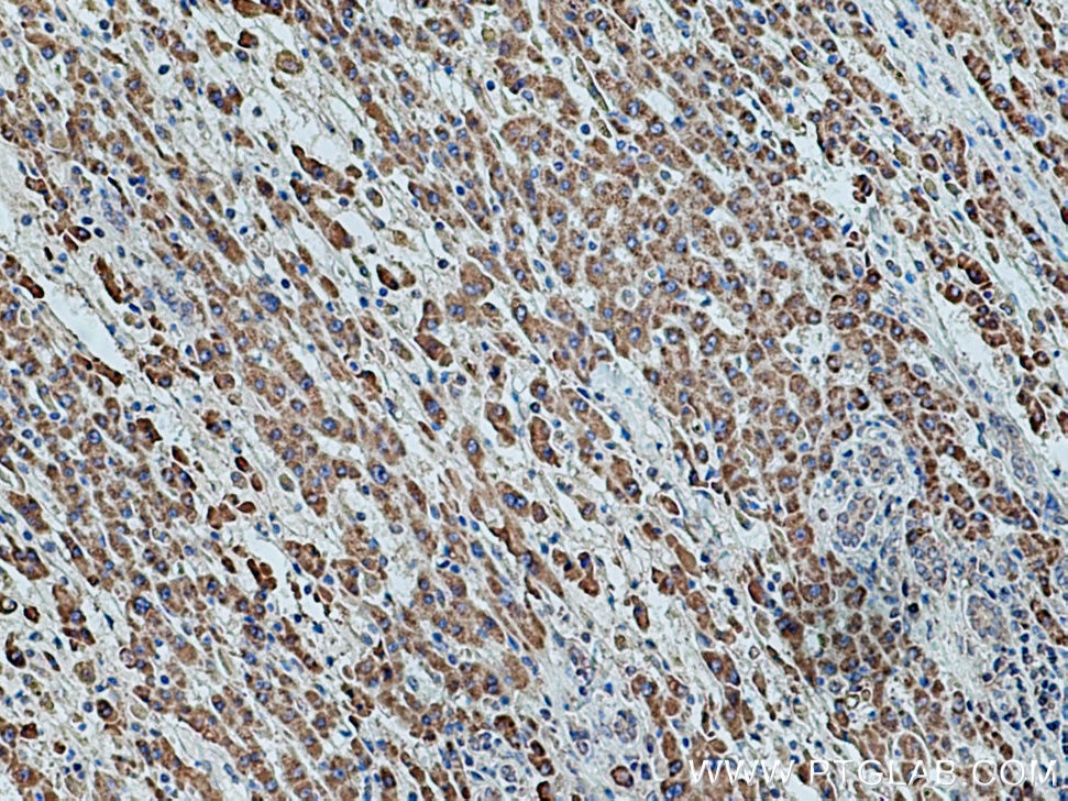 Immunohistochemistry (IHC) staining of human liver cancer tissue using ETFDH Polyclonal antibody (11109-1-AP)
