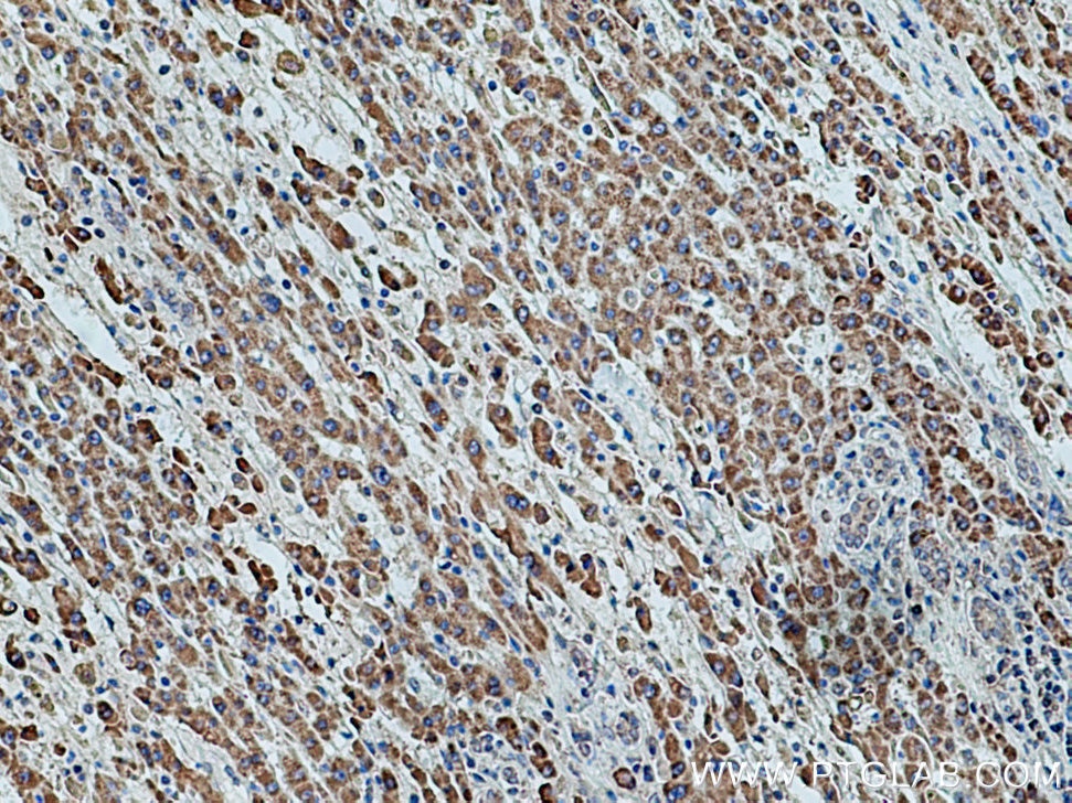 IHC staining of human liver cancer using 11109-1-AP