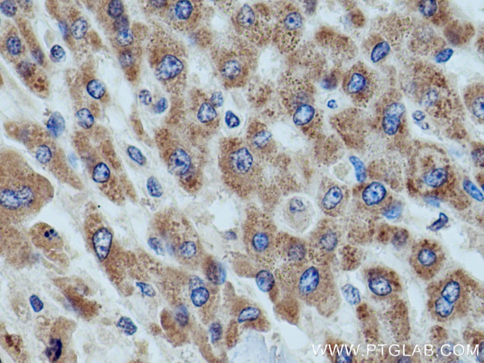Immunohistochemistry (IHC) staining of human liver cancer tissue using ETFDH Polyclonal antibody (11109-1-AP)