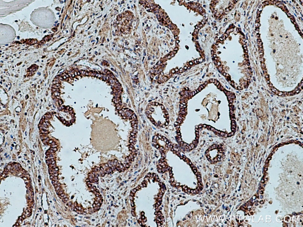 Immunohistochemistry (IHC) staining of human prostate cancer tissue using ETFDH Polyclonal antibody (11109-1-AP)