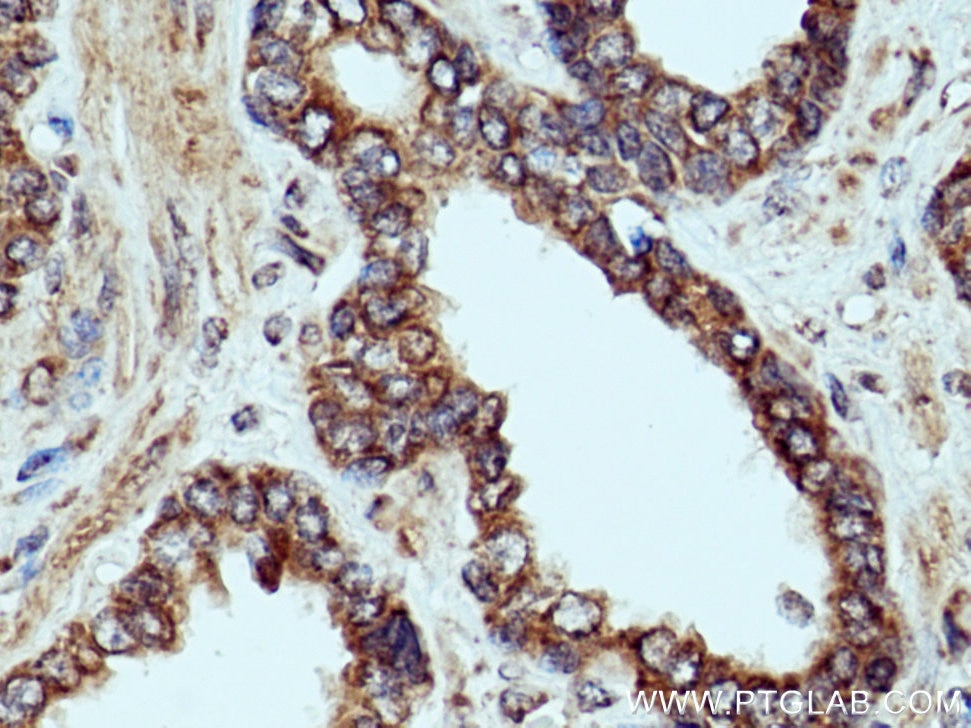 Immunohistochemistry (IHC) staining of human prostate cancer tissue using ETFDH Polyclonal antibody (11109-1-AP)