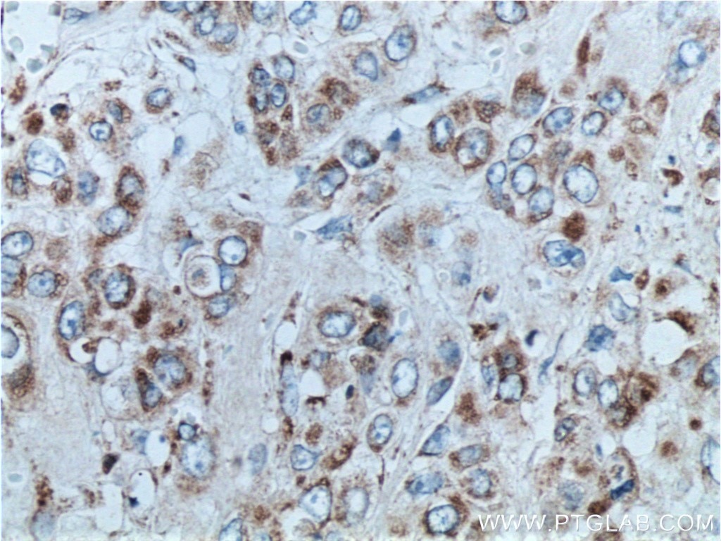 Immunohistochemistry (IHC) staining of human colon cancer tissue using ETHE1 Polyclonal antibody (27786-1-AP)