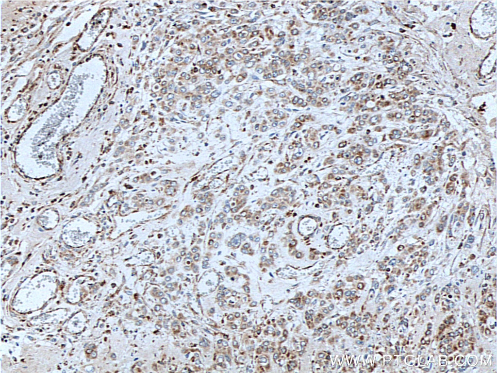 Immunohistochemistry (IHC) staining of human colon cancer tissue using ETHE1 Polyclonal antibody (27786-1-AP)