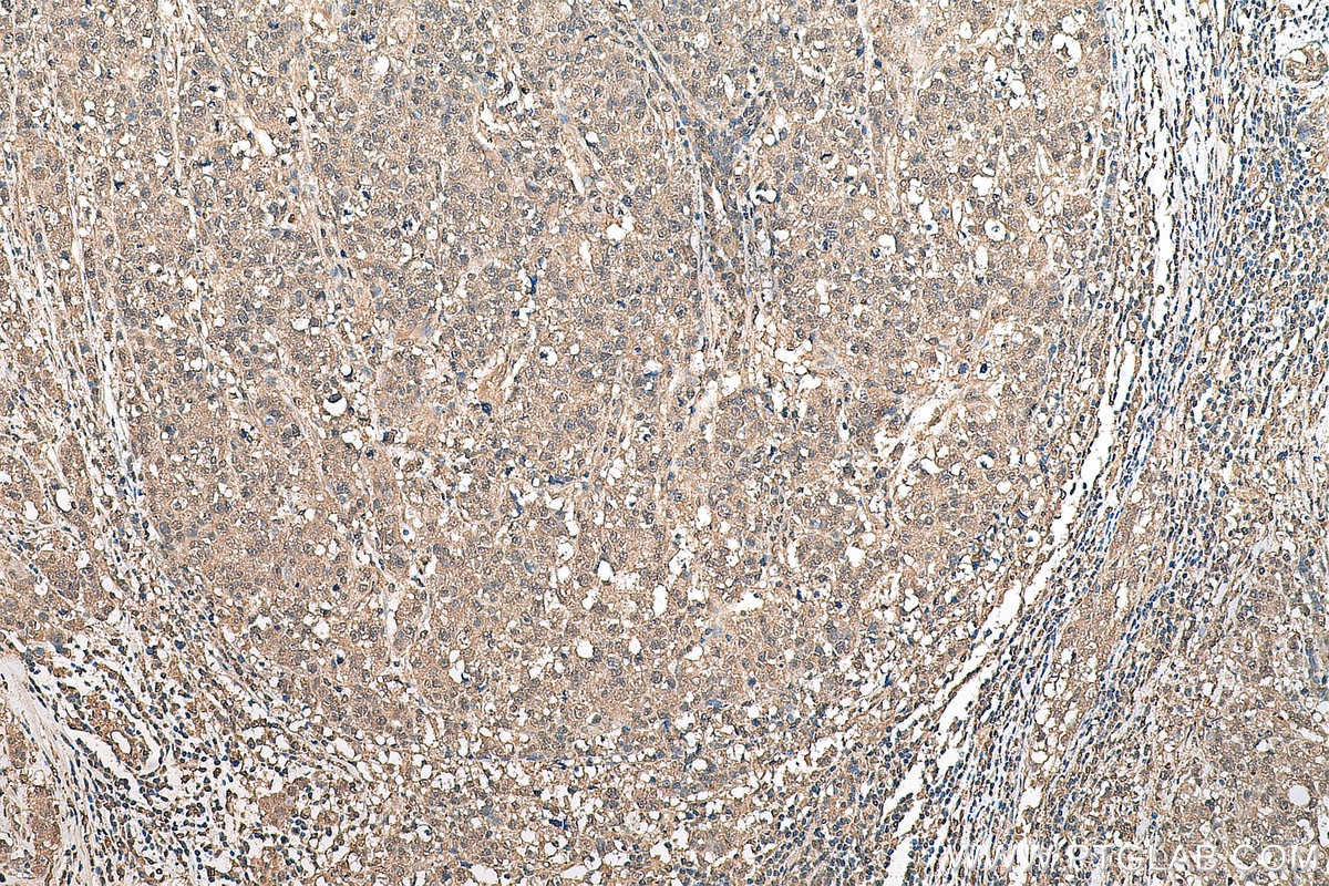 IHC staining of human breast cancer using 67579-1-Ig