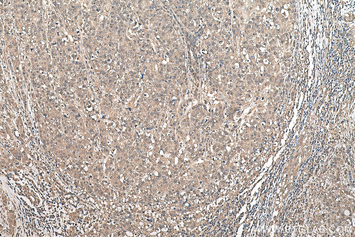 Immunohistochemistry (IHC) staining of human breast cancer tissue using ETV6 Monoclonal antibody (67579-1-Ig)