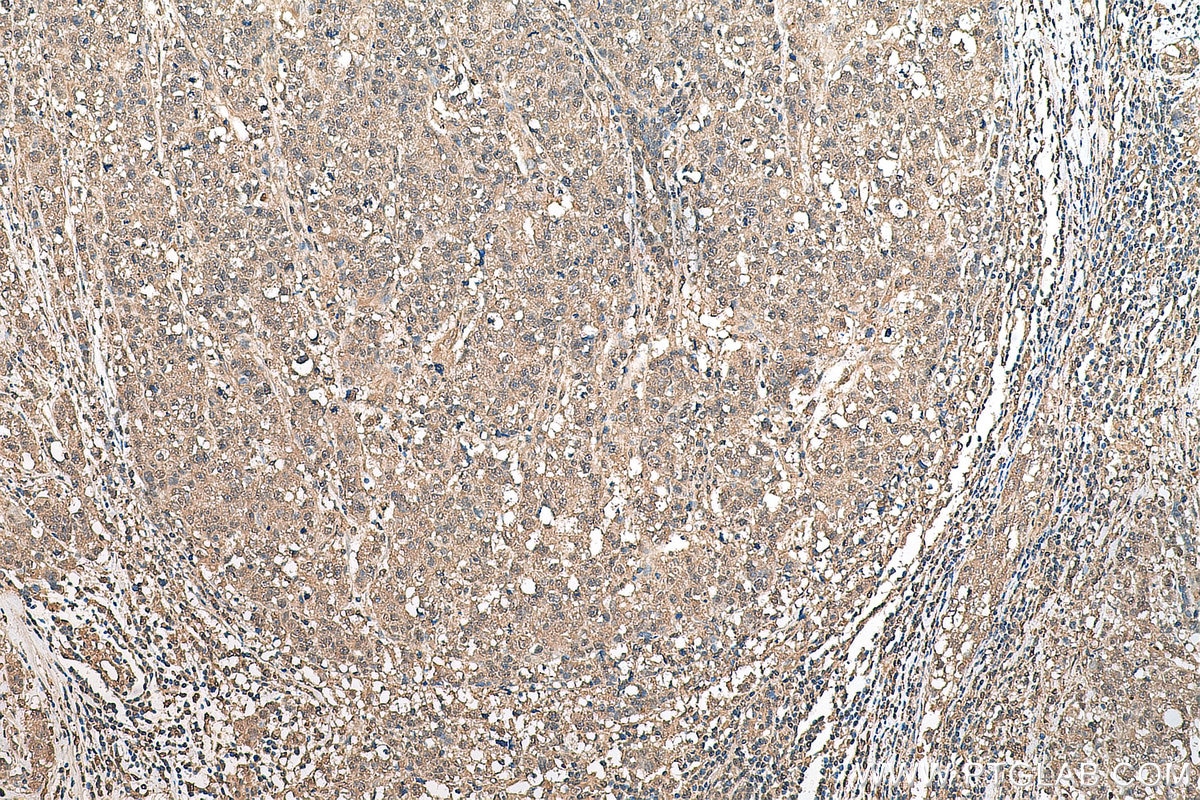 Immunohistochemistry (IHC) staining of human breast cancer tissue using ETV6 Monoclonal antibody (67579-1-Ig)