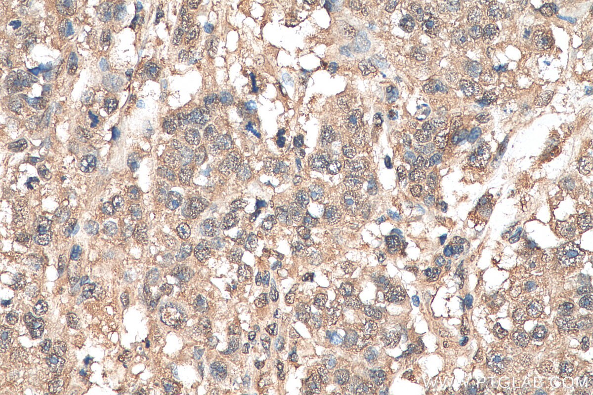 Immunohistochemistry (IHC) staining of human breast cancer tissue using ETV6 Monoclonal antibody (67579-1-Ig)