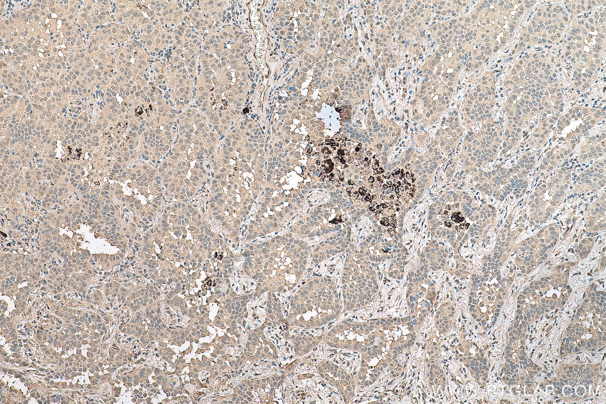 Immunohistochemistry (IHC) staining of human lung cancer tissue using ETV6 Monoclonal antibody (67579-1-Ig)