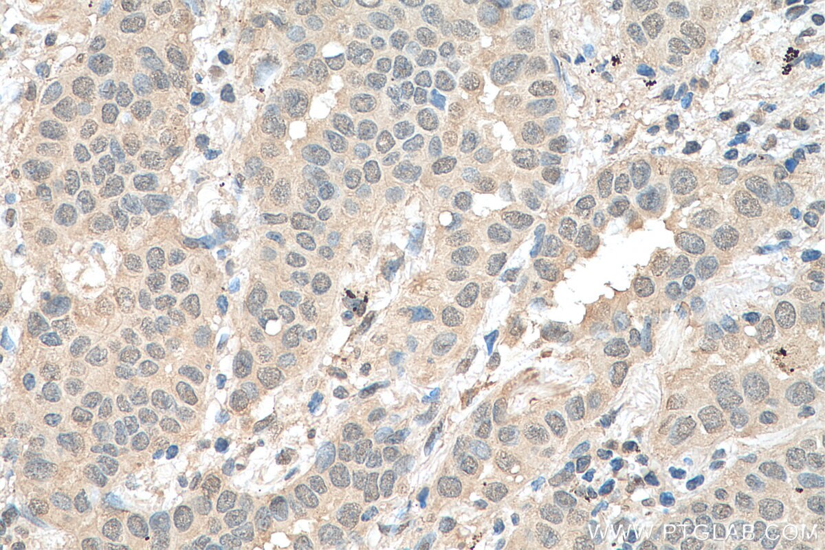 Immunohistochemistry (IHC) staining of human lung cancer tissue using ETV6 Monoclonal antibody (67579-1-Ig)