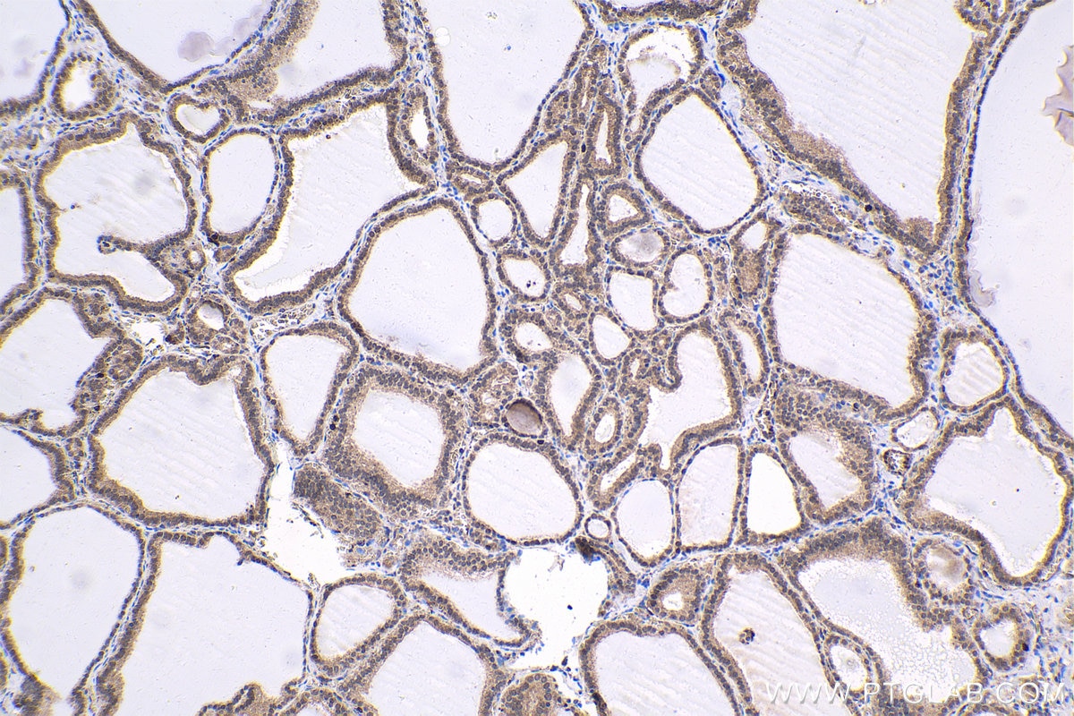 Immunohistochemistry (IHC) staining of human thyroid cancer tissue using EVI1 Polyclonal antibody (23201-1-AP)