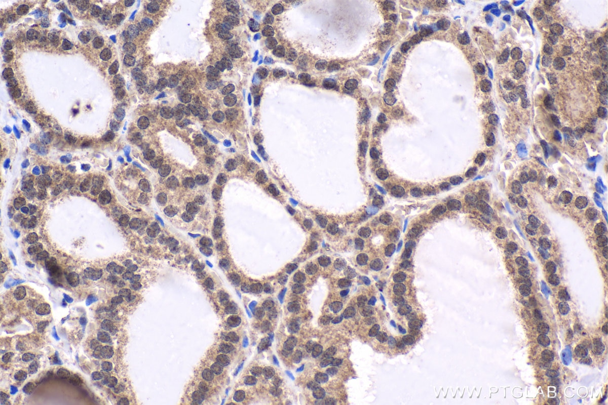 Immunohistochemistry (IHC) staining of human thyroid cancer tissue using EVI1 Polyclonal antibody (23201-1-AP)