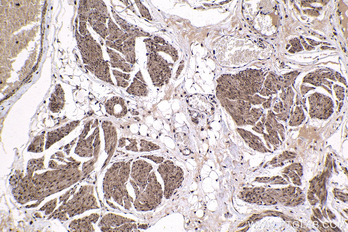 Immunohistochemistry (IHC) staining of human urothelial carcinoma tissue using EVI1 Polyclonal antibody (23201-1-AP)