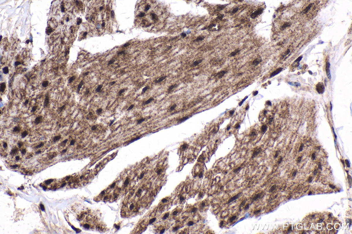 Immunohistochemistry (IHC) staining of human urothelial carcinoma tissue using EVI1 Polyclonal antibody (23201-1-AP)