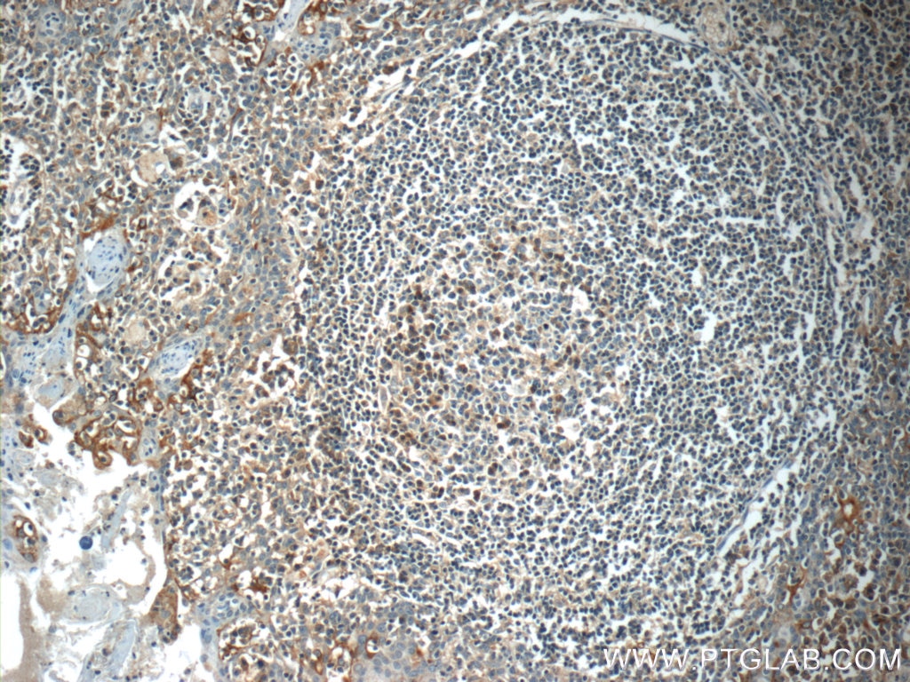 Immunohistochemistry (IHC) staining of human tonsillitis tissue using EVI2B Polyclonal antibody (24891-1-AP)