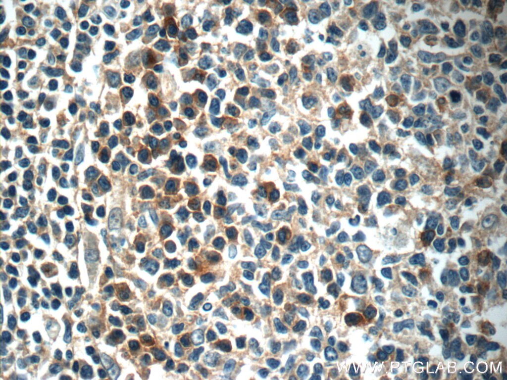 Immunohistochemistry (IHC) staining of human tonsillitis tissue using EVI2B Polyclonal antibody (24891-1-AP)