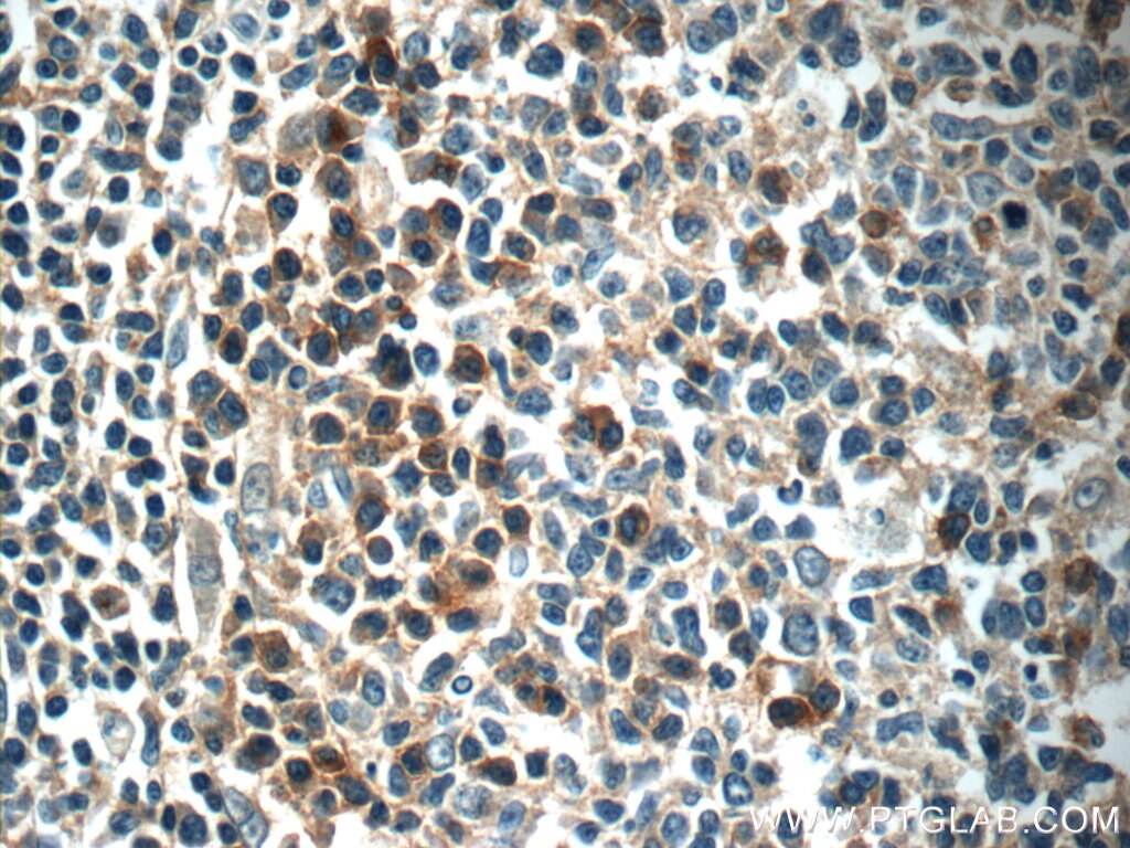 IHC staining of human tonsillitis using 24891-1-AP