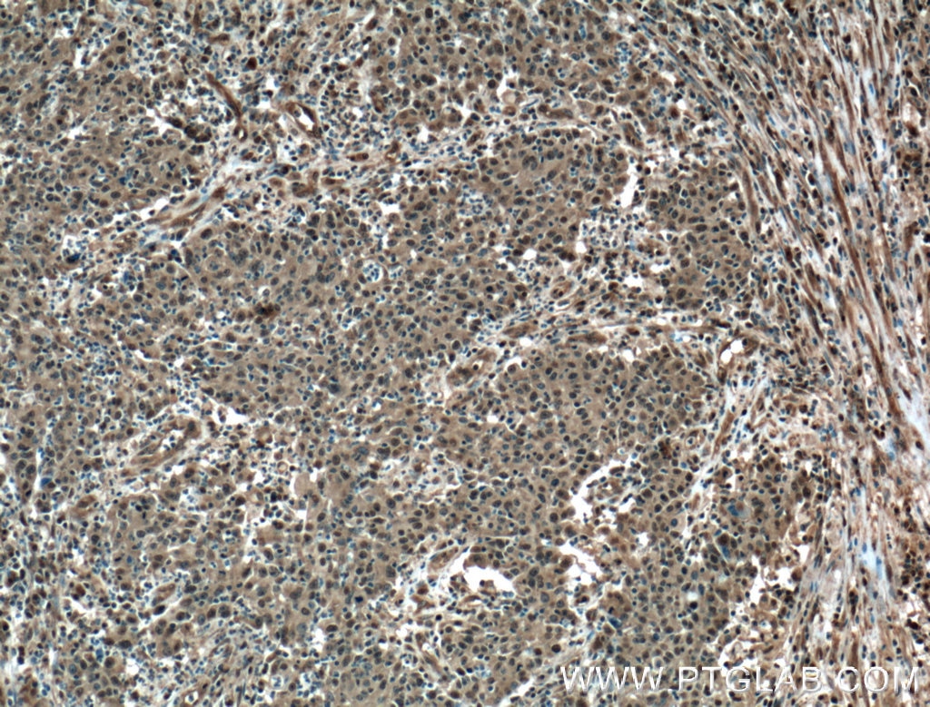 Immunohistochemistry (IHC) staining of human colon cancer tissue using EWS Polyclonal antibody (55191-1-AP)