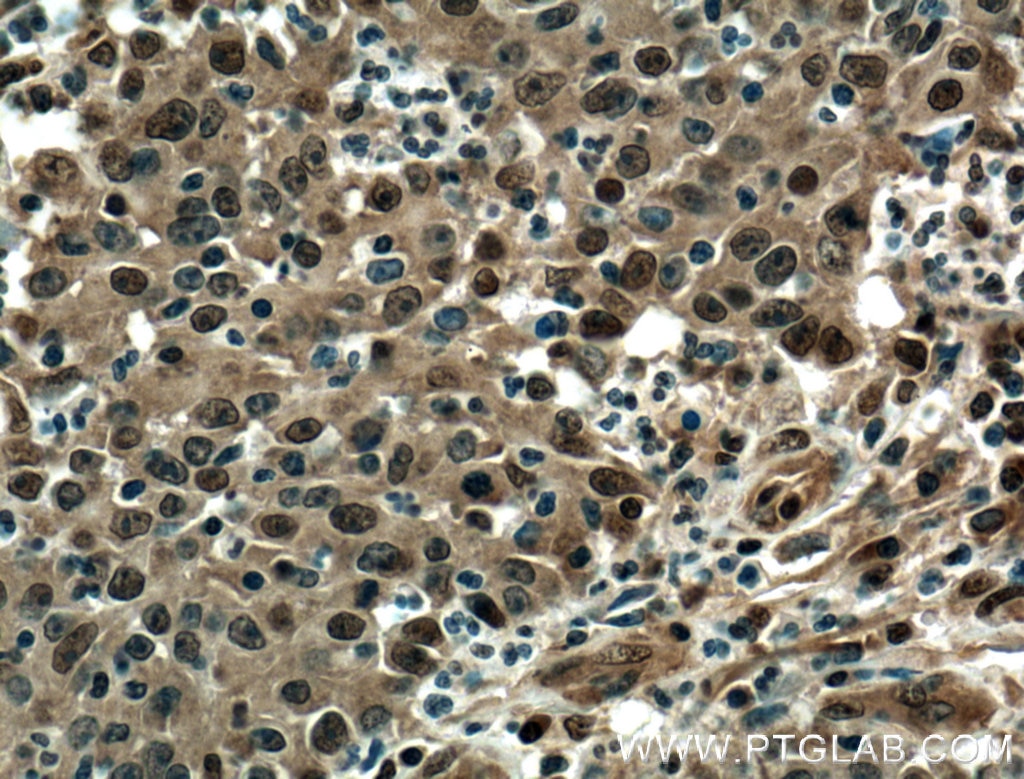 Immunohistochemistry (IHC) staining of human colon cancer tissue using EWS Polyclonal antibody (55191-1-AP)
