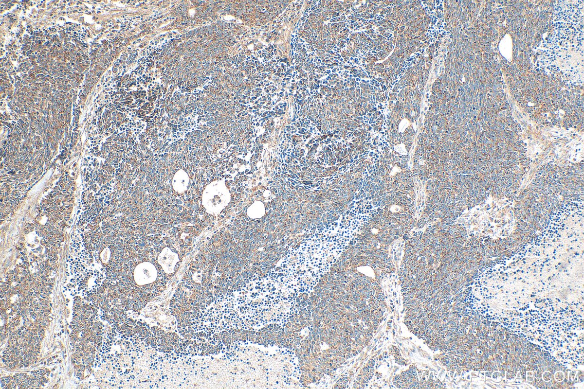 Immunohistochemistry (IHC) staining of human lung cancer tissue using EXD2 Polyclonal antibody (20138-1-AP)