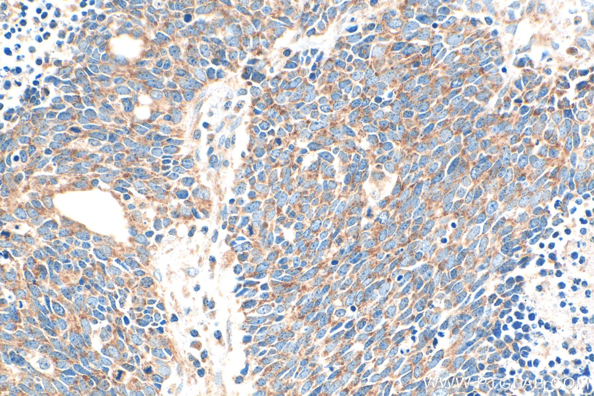 Immunohistochemistry (IHC) staining of human lung cancer tissue using EXD2 Polyclonal antibody (20138-1-AP)