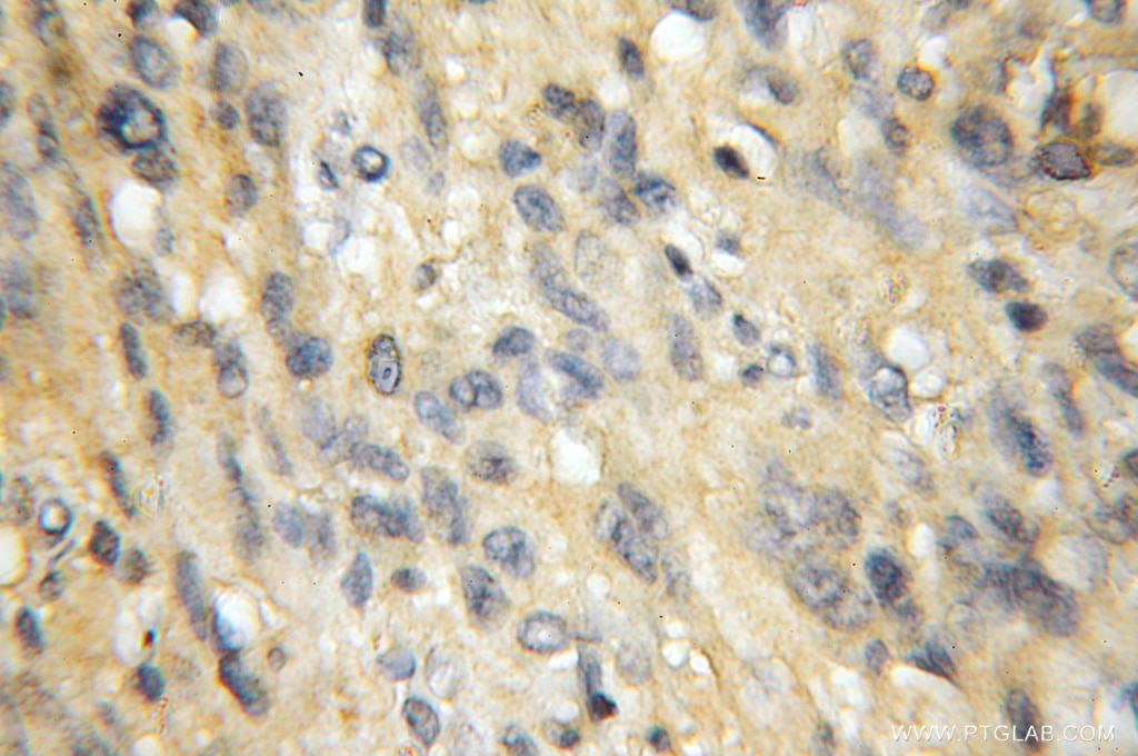 Immunohistochemistry (IHC) staining of human gliomas tissue using EXOC1 Polyclonal antibody (11690-1-AP)