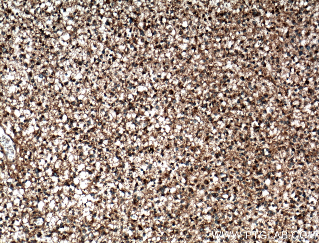 Immunohistochemistry (IHC) staining of human gliomas tissue using SEC6 Polyclonal antibody (14703-1-AP)