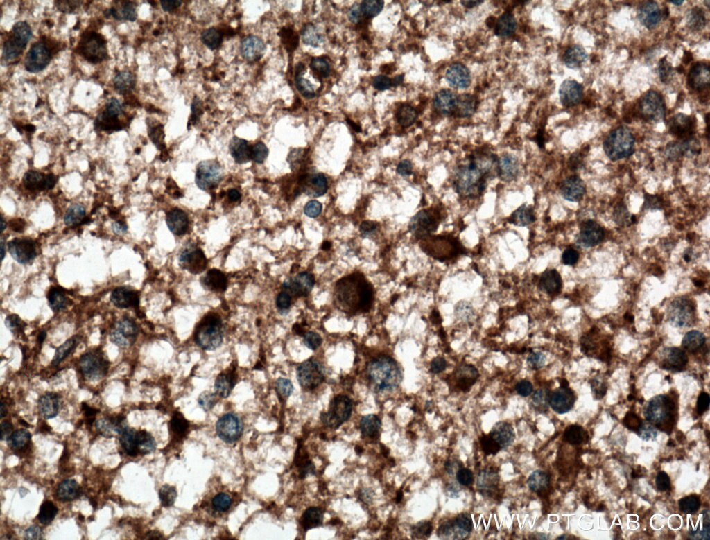 Immunohistochemistry (IHC) staining of human gliomas tissue using SEC6 Polyclonal antibody (14703-1-AP)