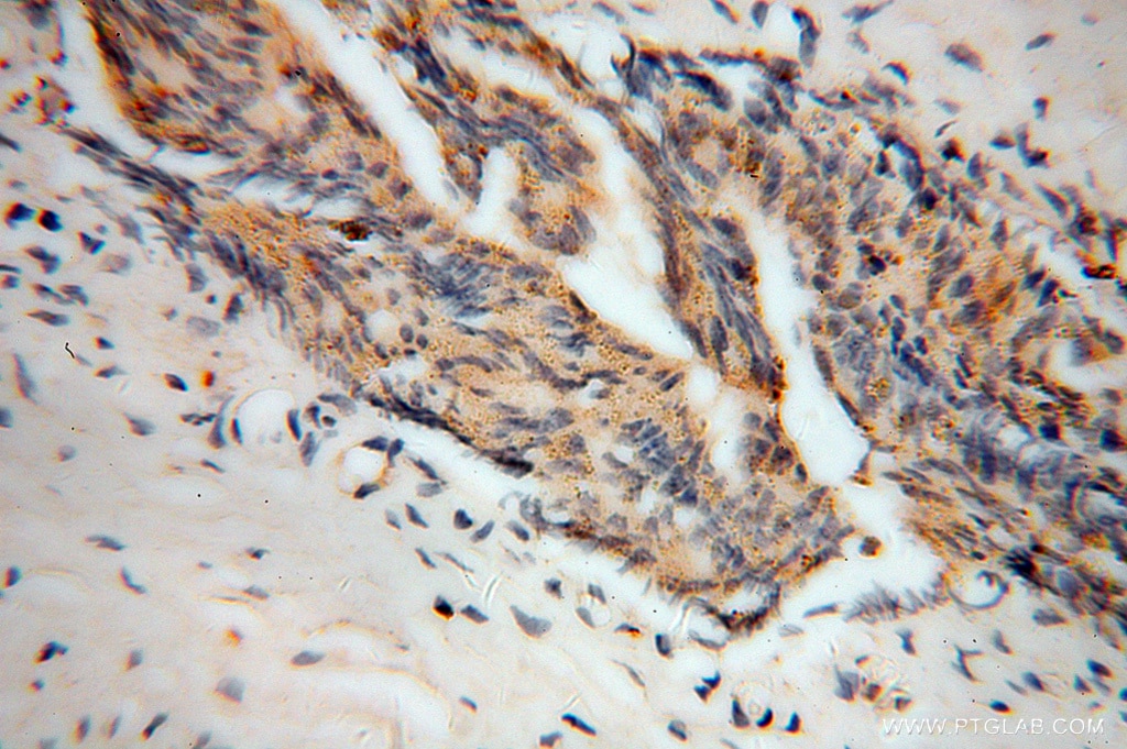 Immunohistochemistry (IHC) staining of human gliomas tissue using SEC6 Polyclonal antibody (14703-1-AP)