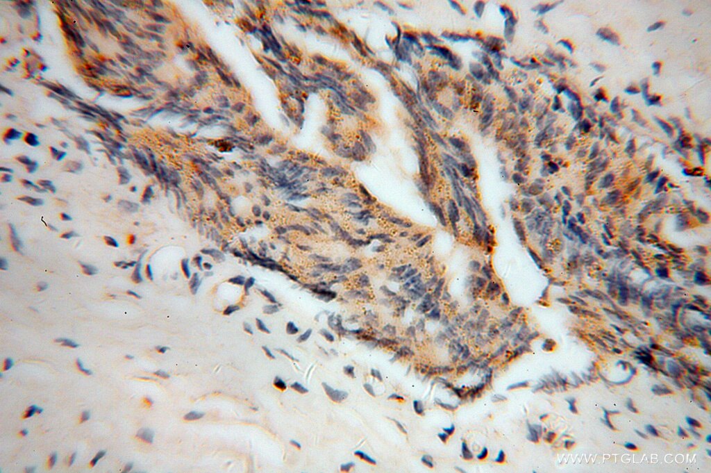 IHC staining of human gliomas using 14703-1-AP