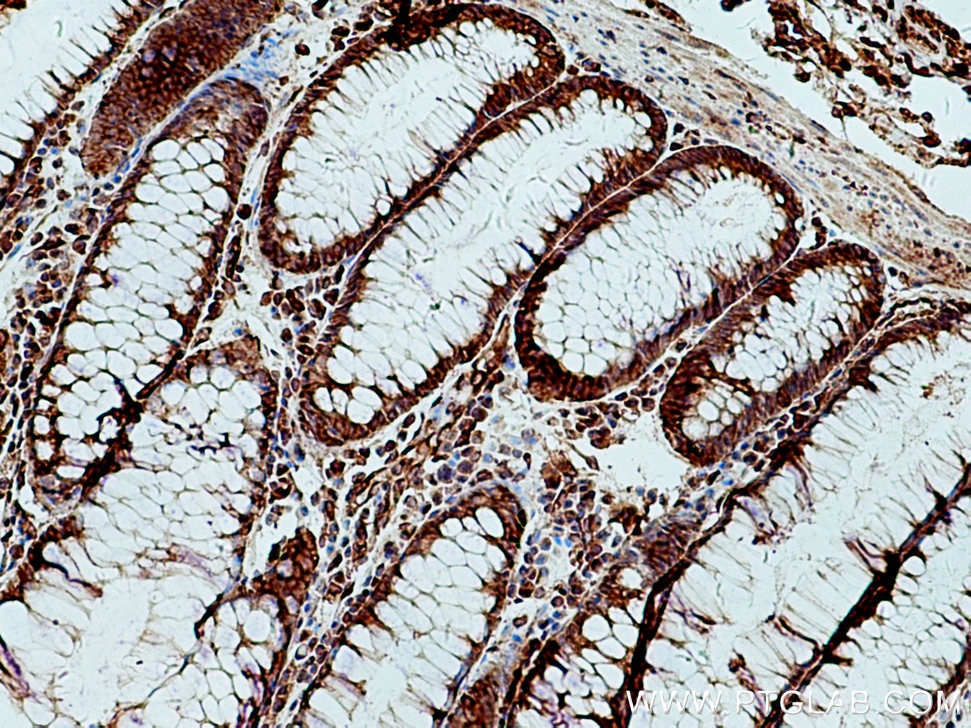 Immunohistochemistry (IHC) staining of human colon cancer tissue using Sec8 Polyclonal antibody (11913-1-AP)
