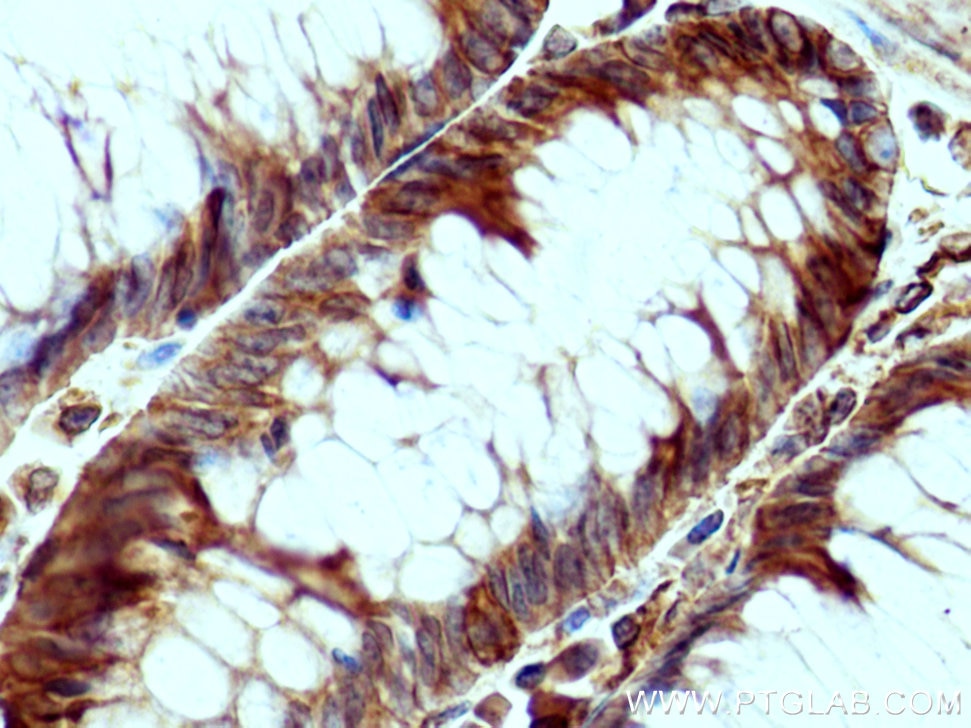 IHC staining of human colon cancer using 11913-1-AP