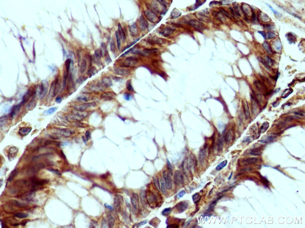 Immunohistochemistry (IHC) staining of human colon cancer tissue using Sec8 Polyclonal antibody (11913-1-AP)