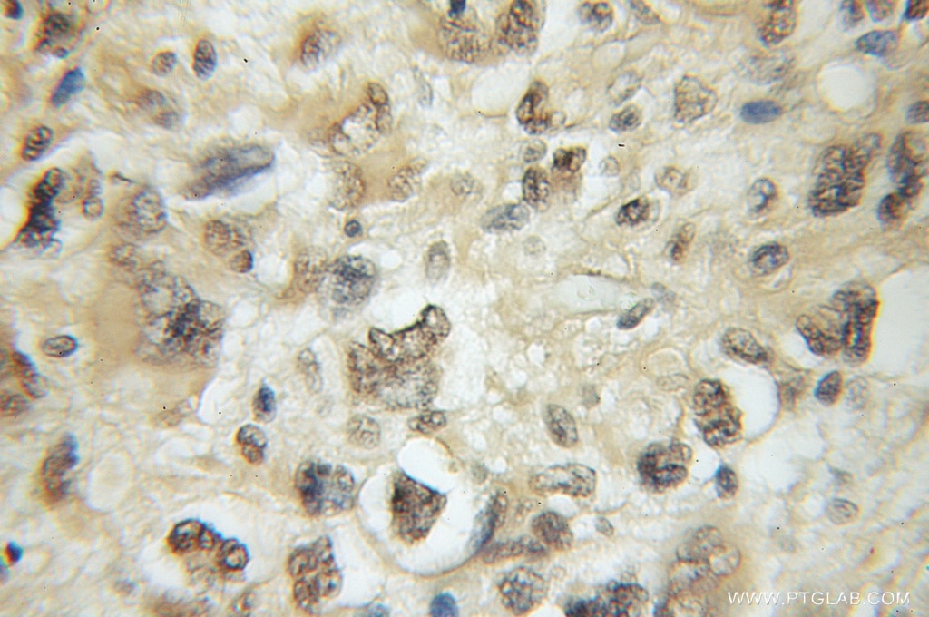 IHC staining of human gliomas using 12014-1-AP