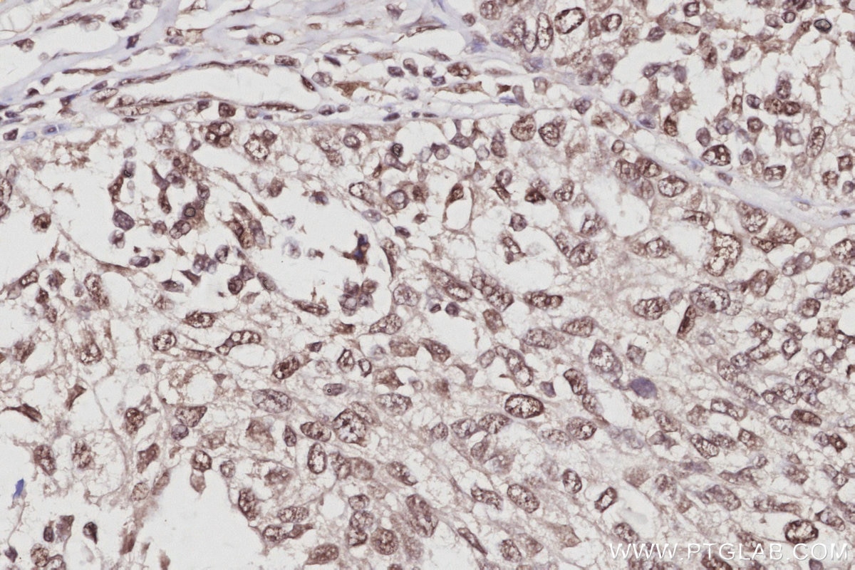 Immunohistochemistry (IHC) staining of human ovary cancer tissue using EXOSC1 Polyclonal antibody (12585-1-AP)