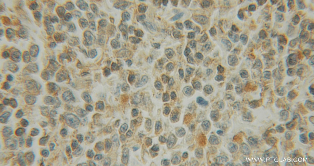 Immunohistochemistry (IHC) staining of human lymphoma tissue using EXOSC1 Polyclonal antibody (12585-1-AP)