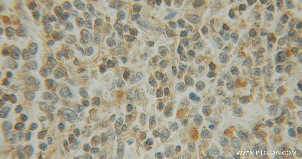 Immunohistochemistry (IHC) staining of human lymphoma tissue using EXOSC1 Polyclonal antibody (12585-1-AP)