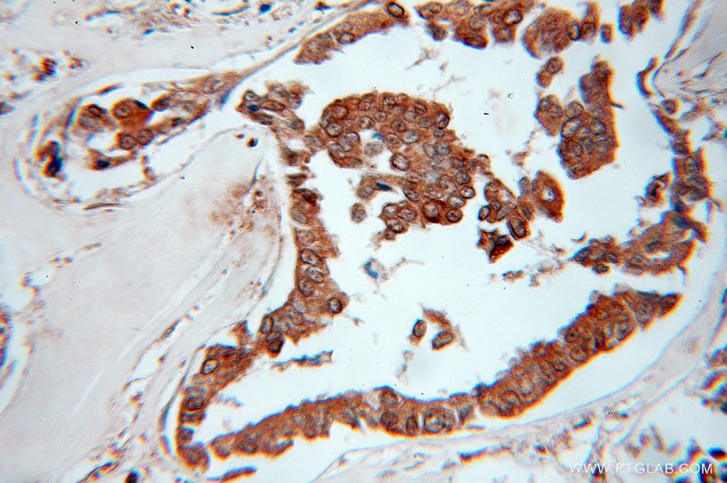 Immunohistochemistry (IHC) staining of human breast cancer tissue using EXOSC10 Polyclonal antibody (11178-1-AP)