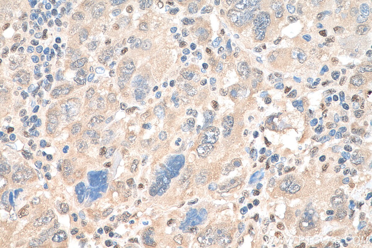 Immunohistochemistry (IHC) staining of human liver cancer tissue using EXOSC10 Polyclonal antibody (16731-1-AP)