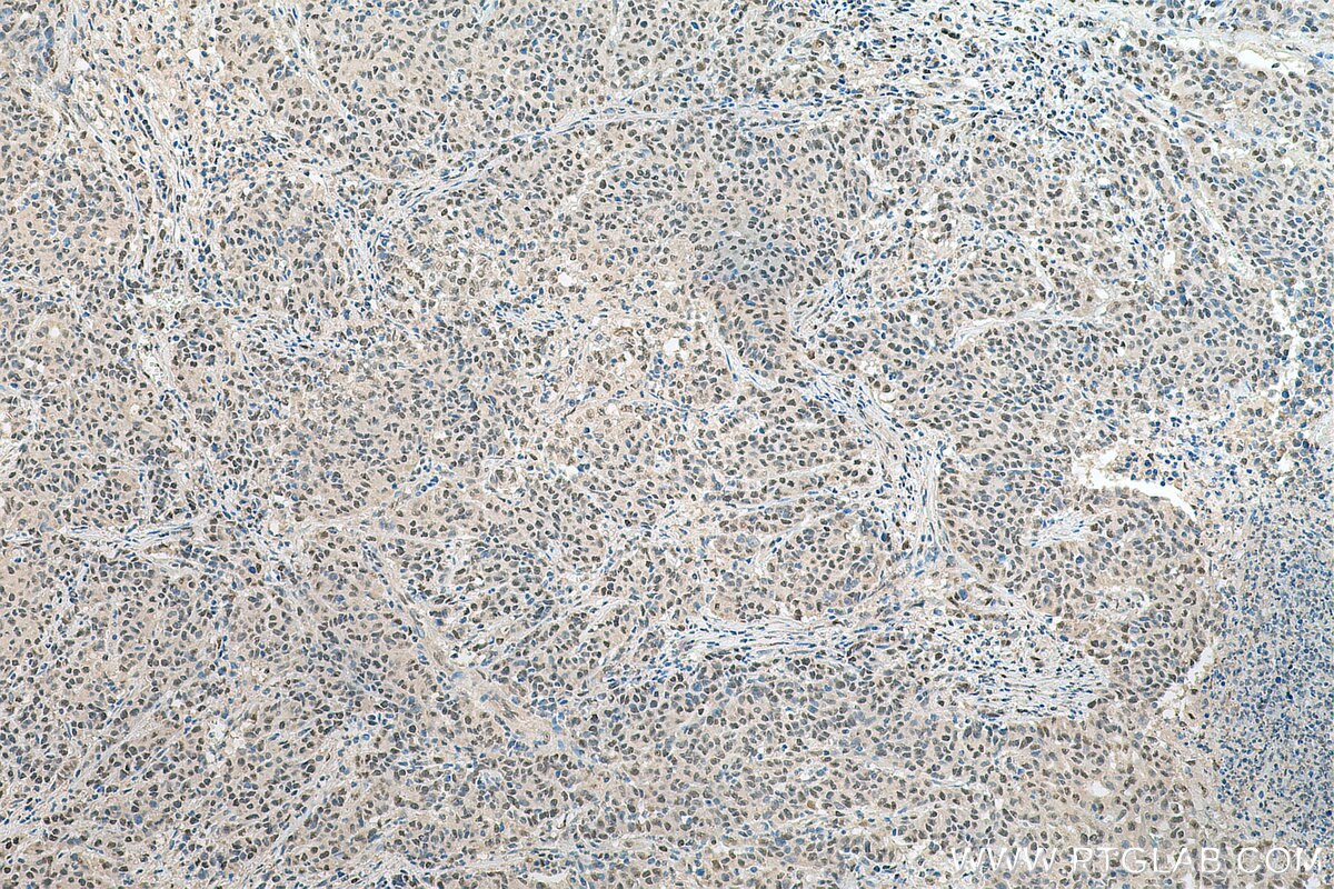 Immunohistochemistry (IHC) staining of human stomach cancer tissue using EXOSC10 Polyclonal antibody (16731-1-AP)