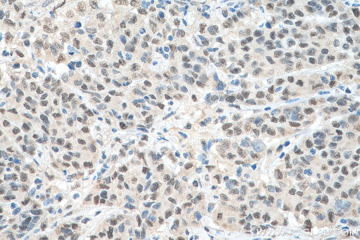 Immunohistochemistry (IHC) staining of human stomach cancer tissue using EXOSC10 Polyclonal antibody (16731-1-AP)