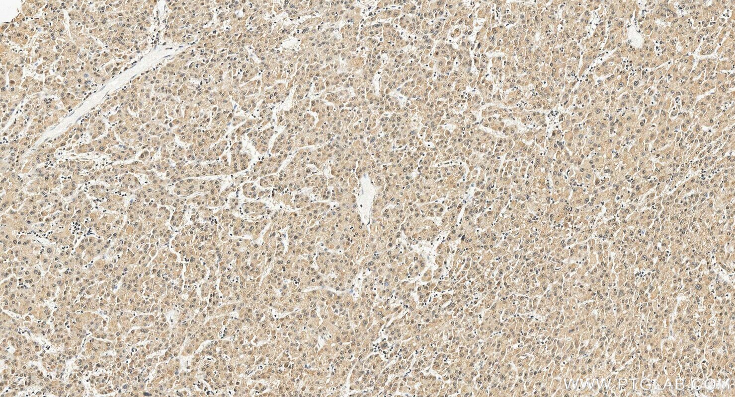 IHC staining of human liver cancer using 68315-1-Ig Immunohistochemistry (IHC) staining of human liver cancer tissue using EXOSC10 Monoclonal antibody (68315-1-Ig)