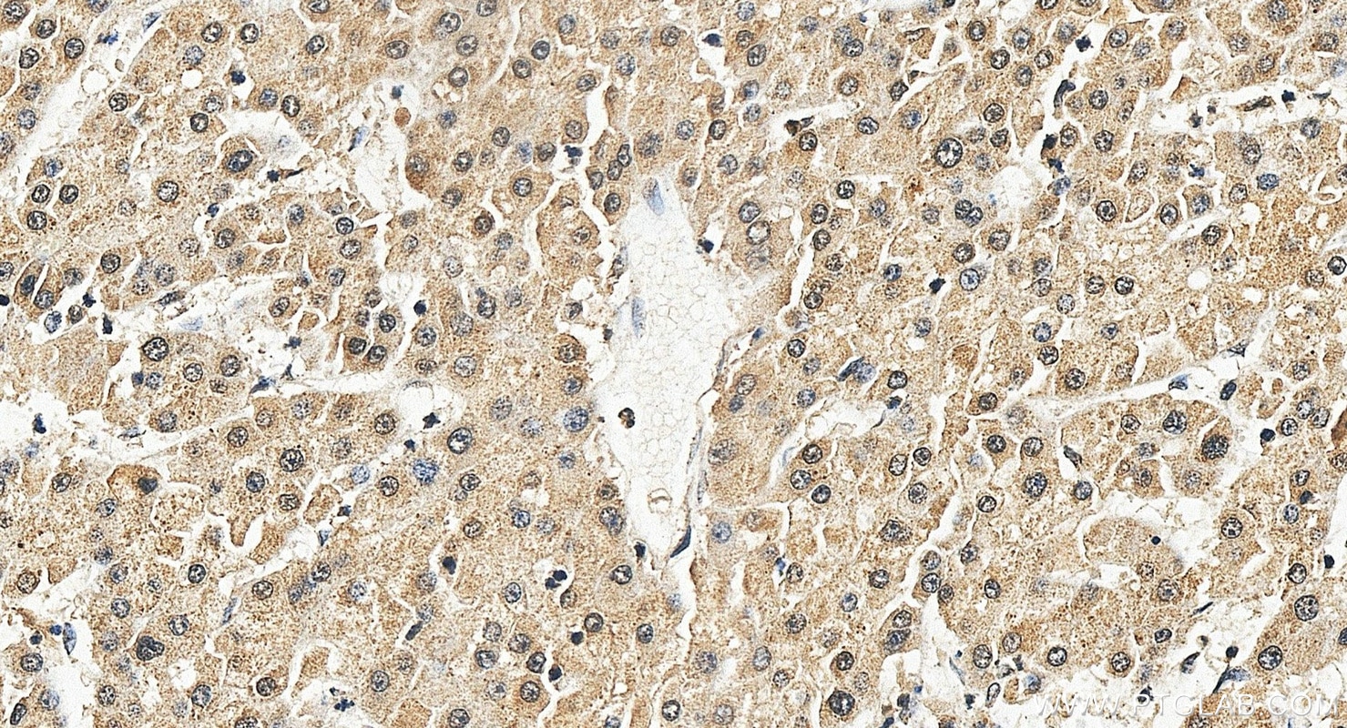 IHC staining of human liver cancer using 68315-1-Ig Immunohistochemistry (IHC) staining of human liver cancer tissue using EXOSC10 Monoclonal antibody (68315-1-Ig)