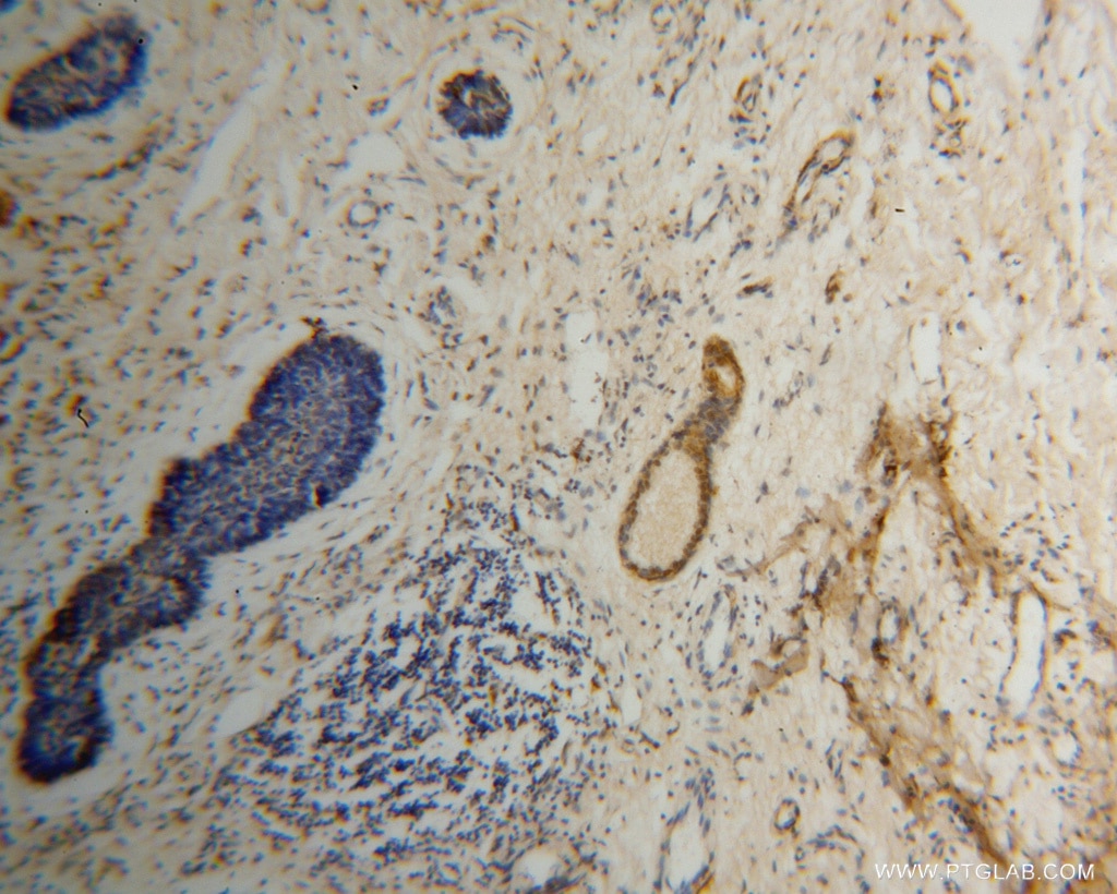 Immunohistochemistry (IHC) staining of human skin cancer tissue using EXOSC2 Polyclonal antibody (14805-1-AP)