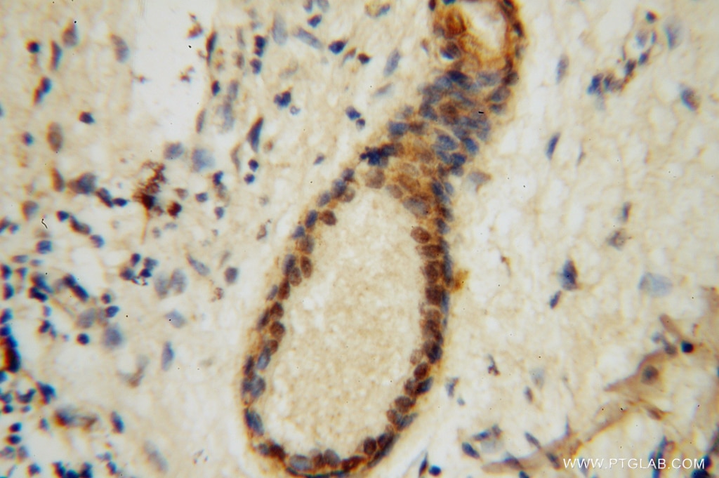 IHC staining of human skin cancer using 14805-1-AP