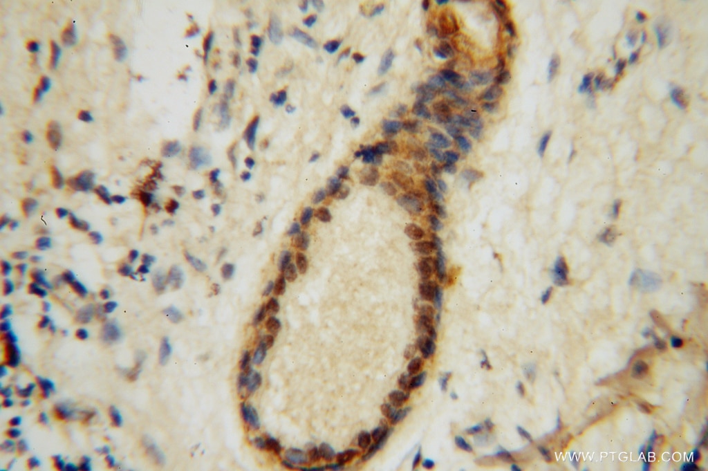 Immunohistochemistry (IHC) staining of human skin cancer tissue using EXOSC2 Polyclonal antibody (14805-1-AP)