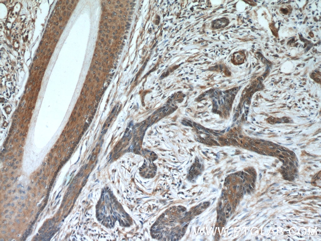Immunohistochemistry (IHC) staining of human skin cancer tissue using EXOSC2 Monoclonal antibody (66099-1-Ig)